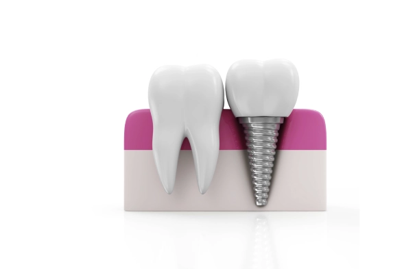 single tooth implants 2